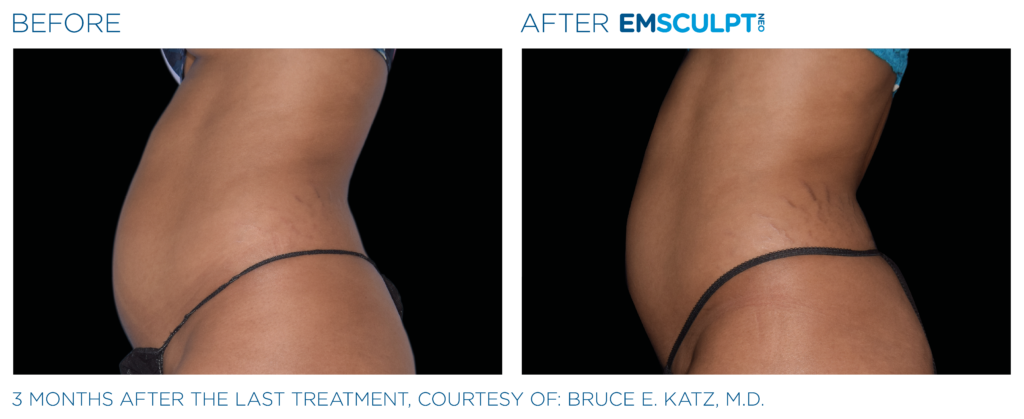 Emsculpt NEO before and after