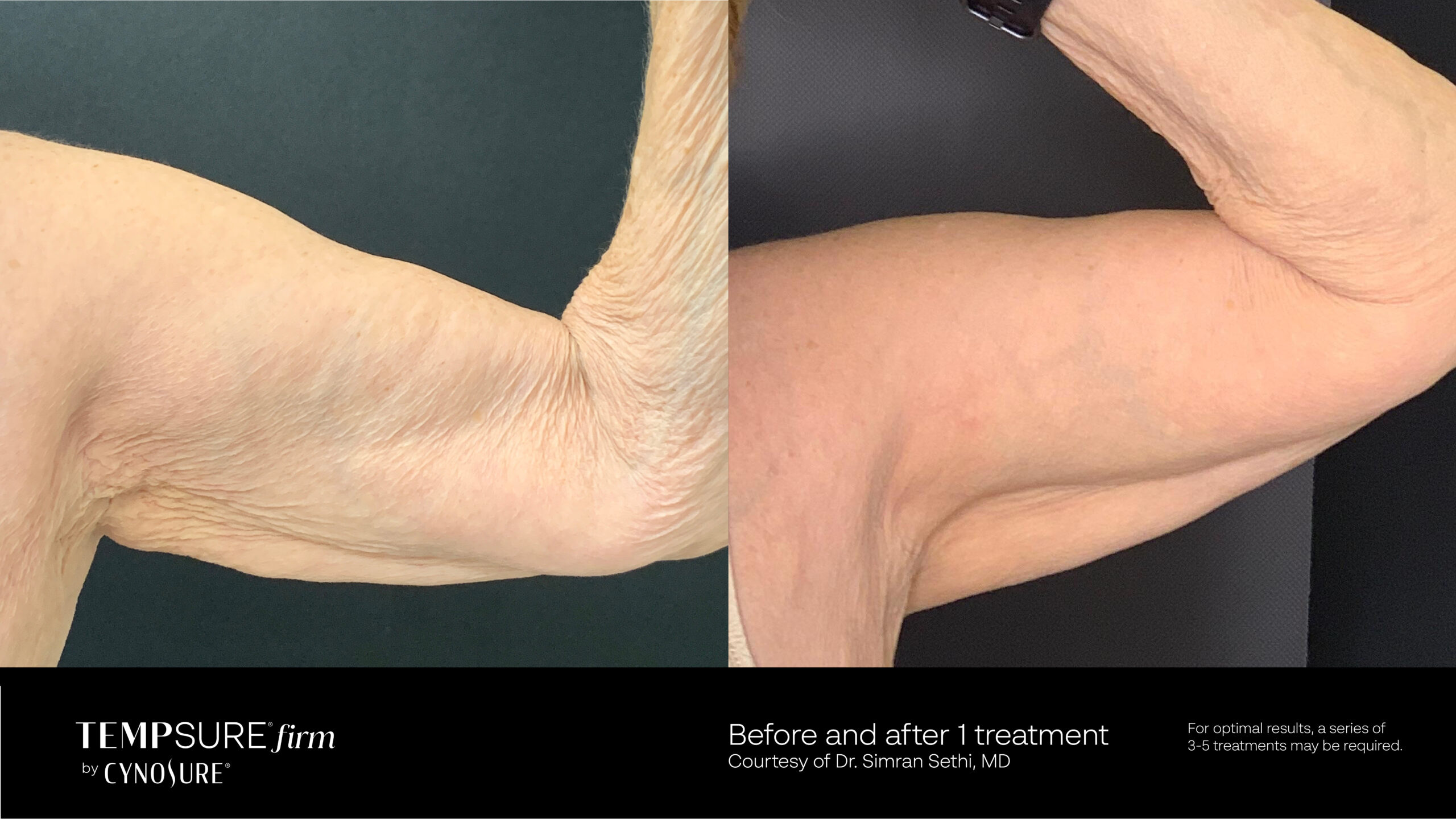 TempSure Firm Radiofrequency Skin Tightening