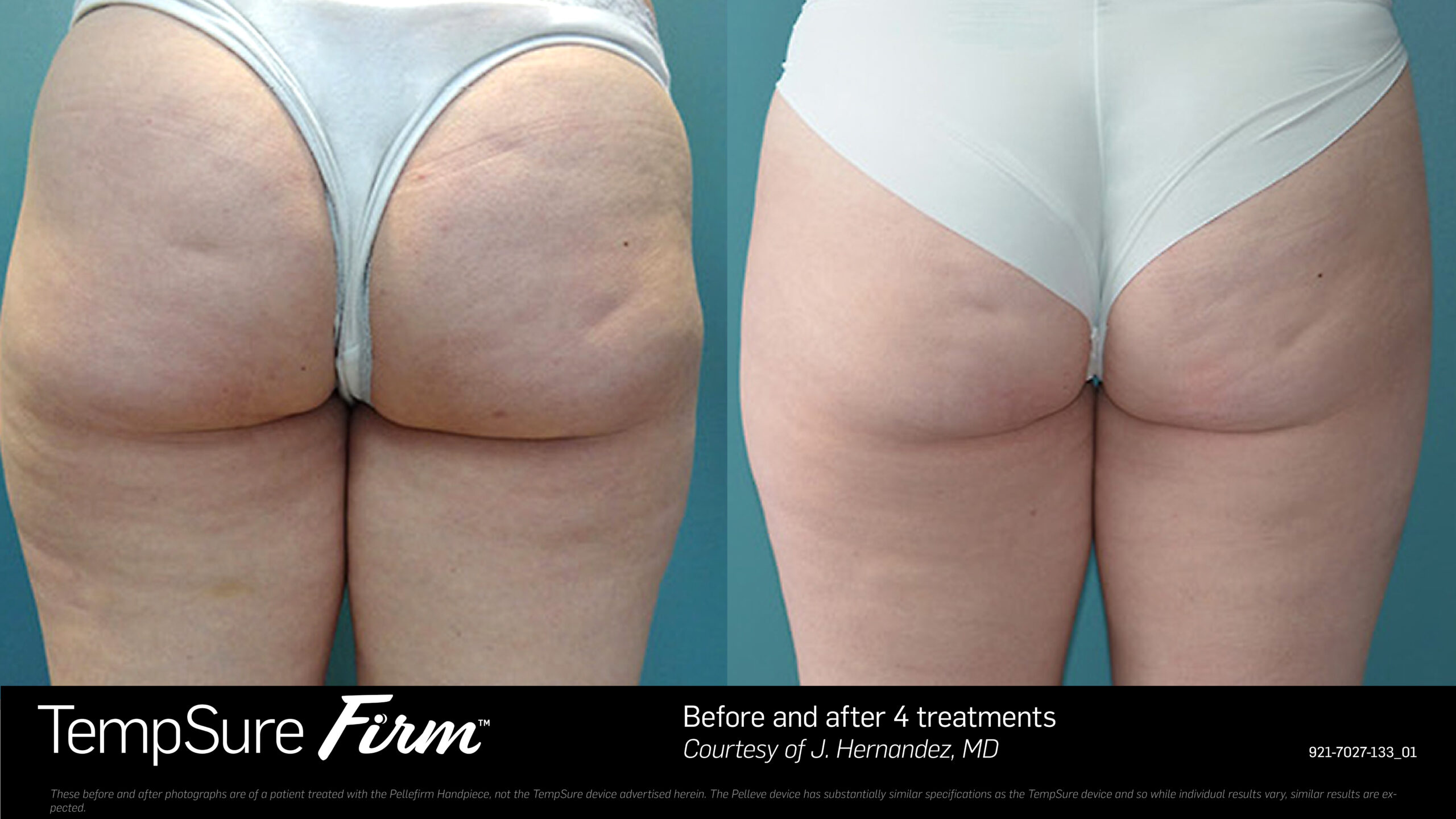 TempSure Firm Radiofrequency Skin Tightening